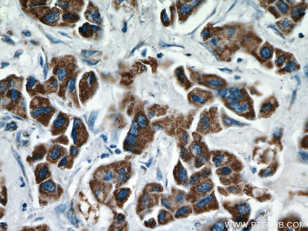 Immunohistochemistry (IHC) staining of human breast cancer tissue using FMO5-specific Polyclonal antibody (16864-1-AP)
