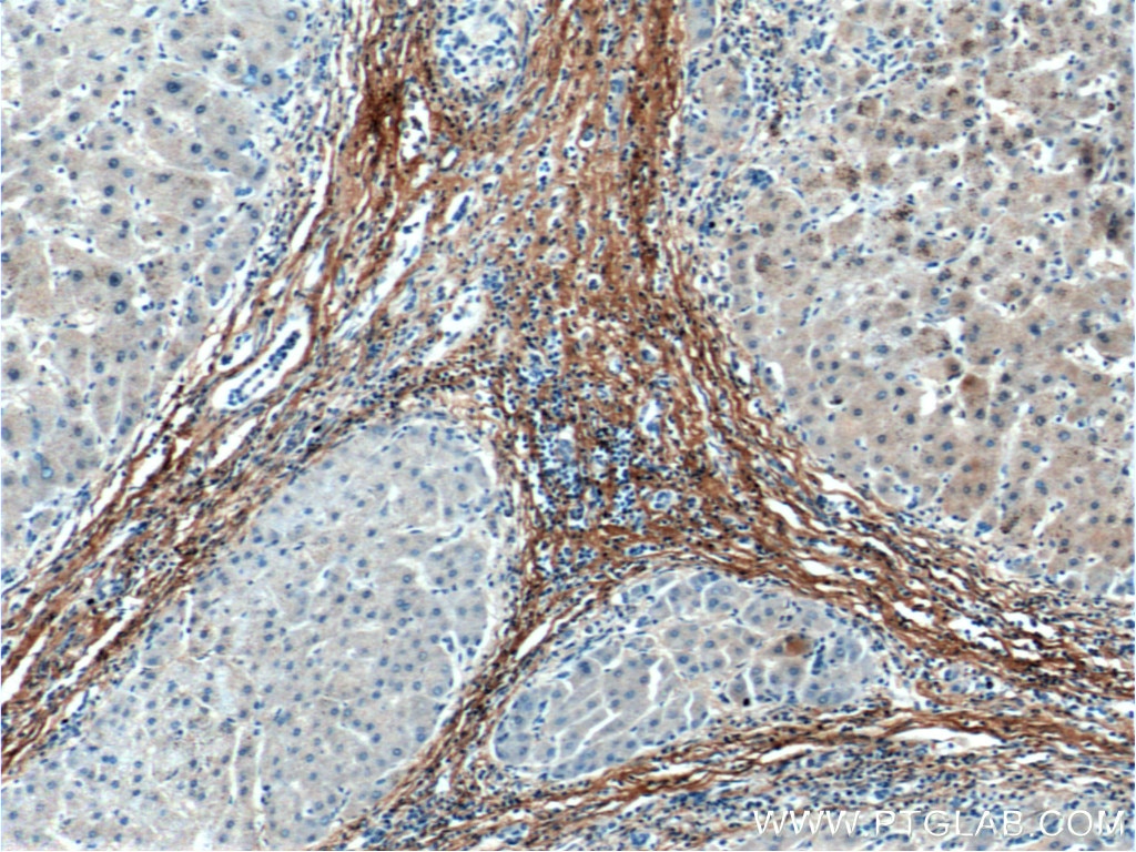 Immunohistochemistry (IHC) staining of human hepatocirrhosis tissue using Fibromodulin Monoclonal antibody (60108-1-Ig)