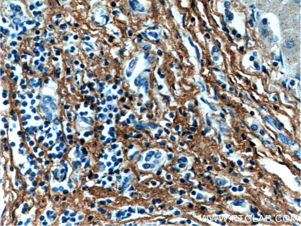 Immunohistochemistry (IHC) staining of human hepatocirrhosis tissue using Fibromodulin Monoclonal antibody (60108-1-Ig)