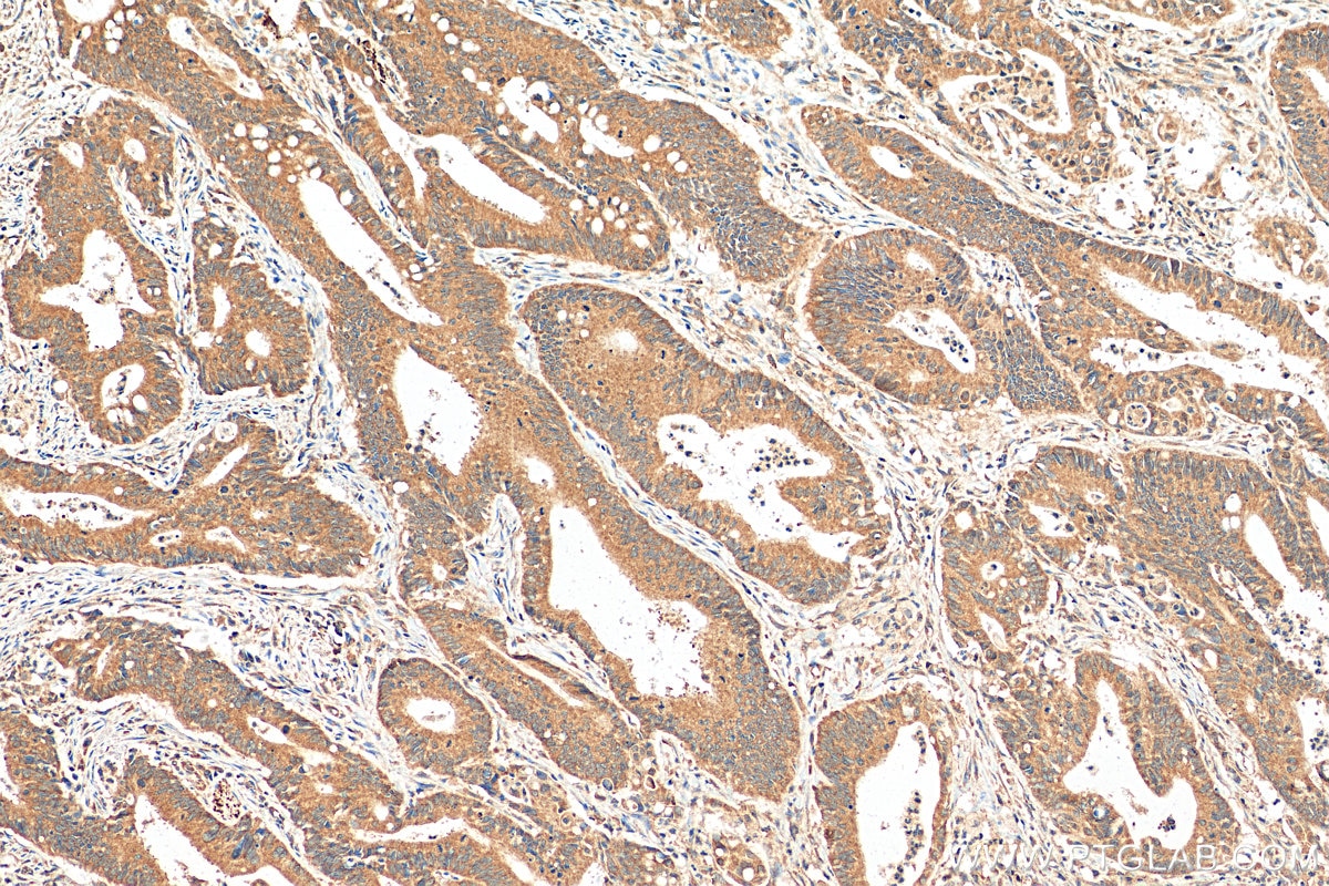 Immunohistochemistry (IHC) staining of human colon cancer tissue using FMR1 Polyclonal antibody (13755-1-AP)