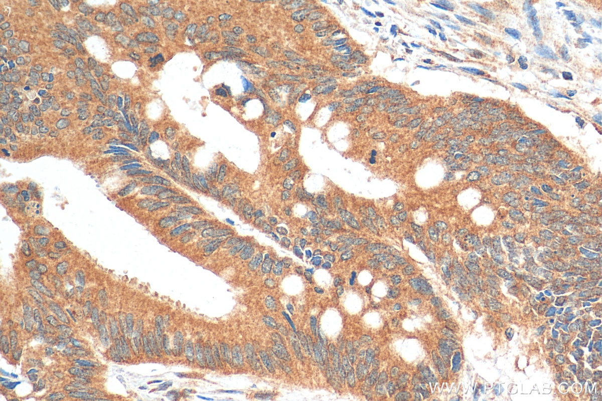 Immunohistochemistry (IHC) staining of human colon cancer tissue using FMR1 Polyclonal antibody (13755-1-AP)