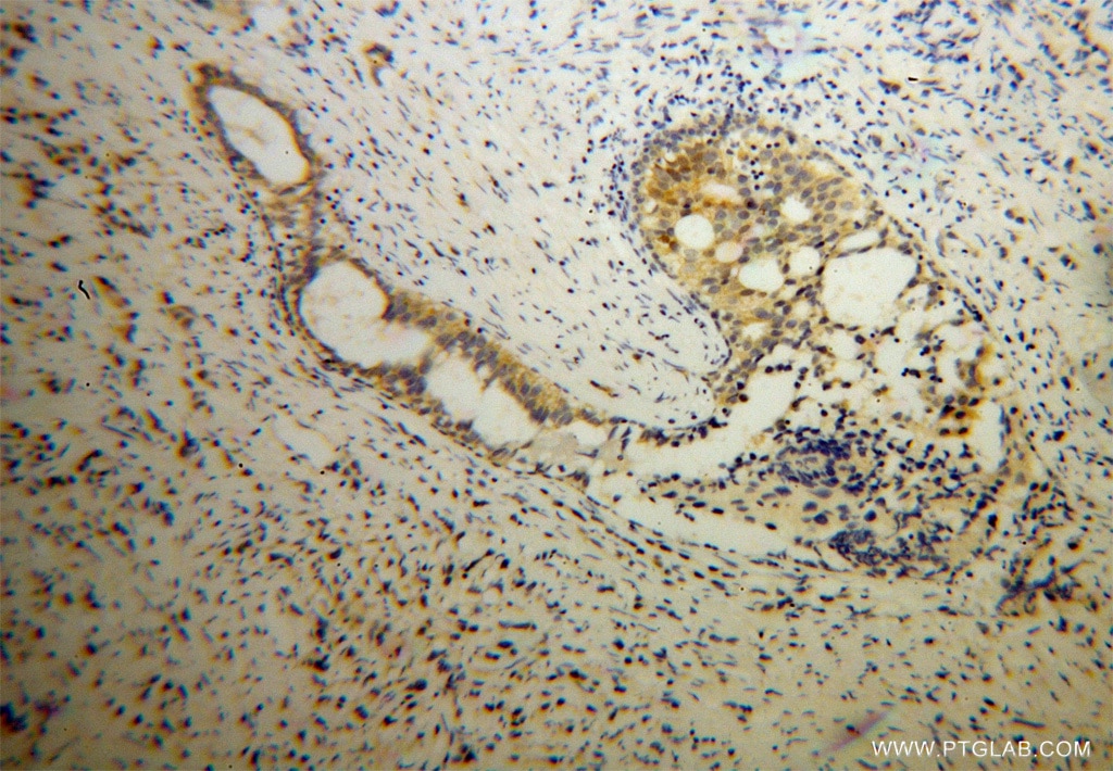 IHC staining of human gliomas using 13755-1-AP