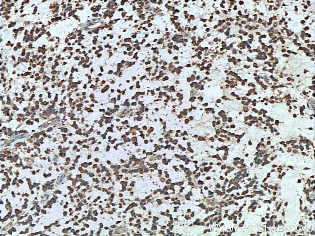 Immunohistochemistry (IHC) staining of human gliomas tissue using FMR1 Monoclonal antibody (66548-1-Ig)