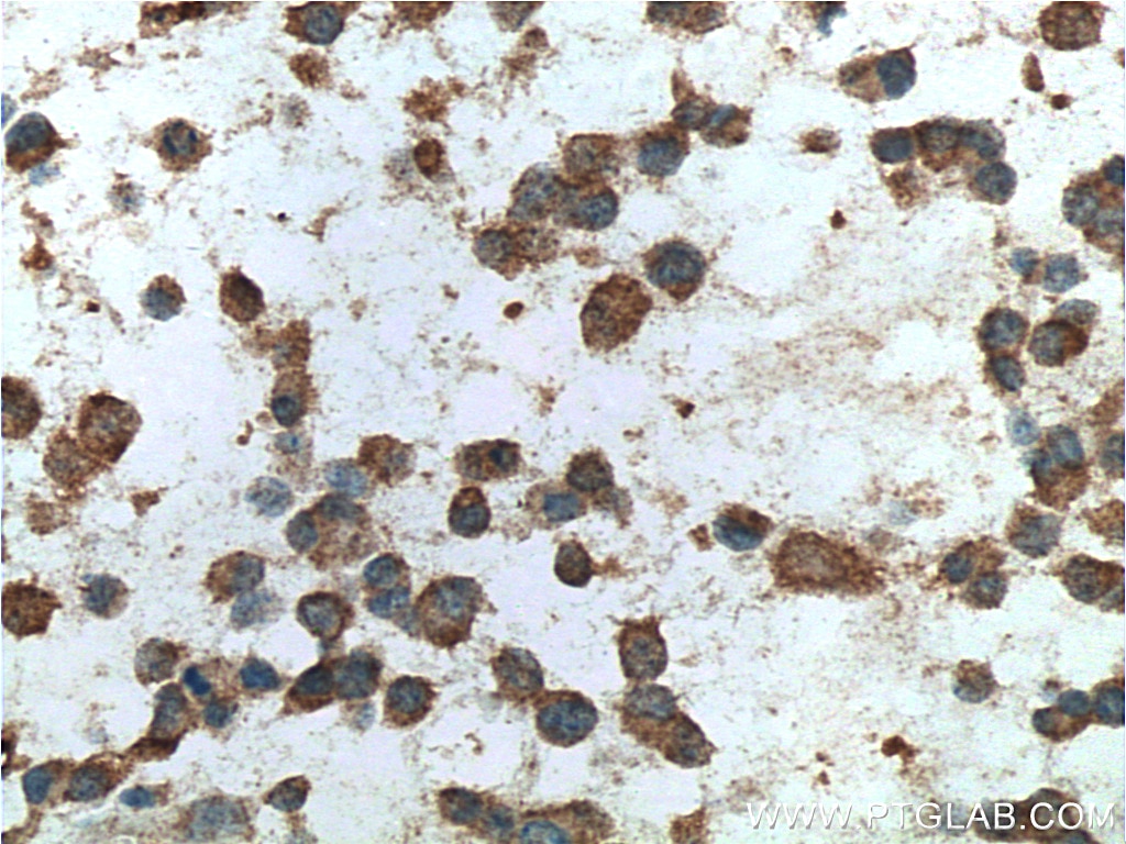 Immunohistochemistry (IHC) staining of human gliomas tissue using FMR1 Monoclonal antibody (66548-1-Ig)