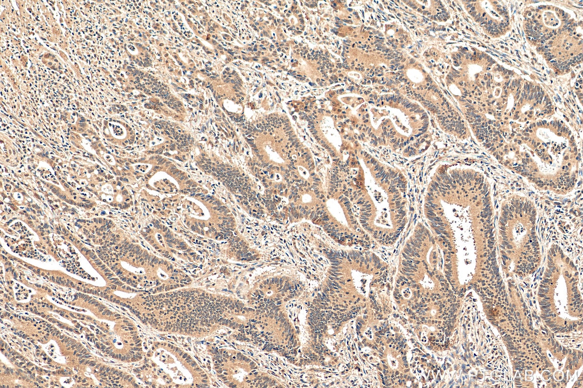 Immunohistochemistry (IHC) staining of human colon cancer tissue using FMR1 Monoclonal antibody (66548-1-Ig)