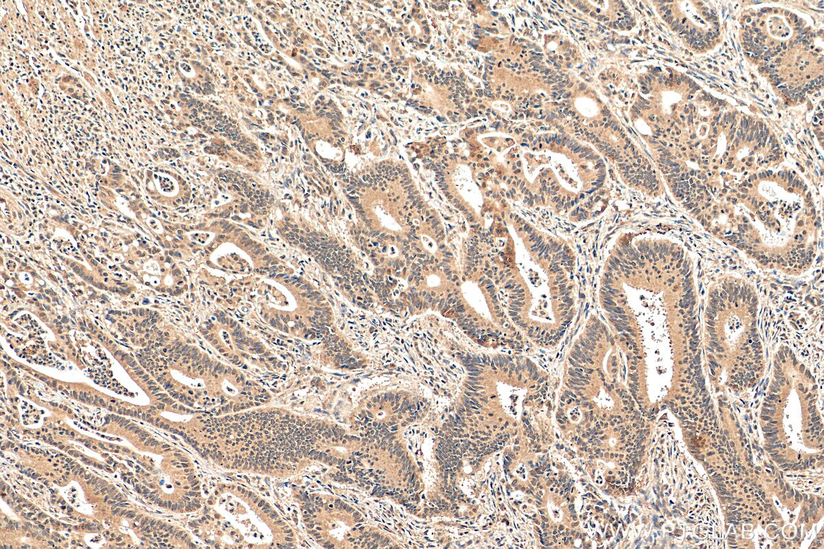 IHC staining of human colon cancer using 66548-1-Ig