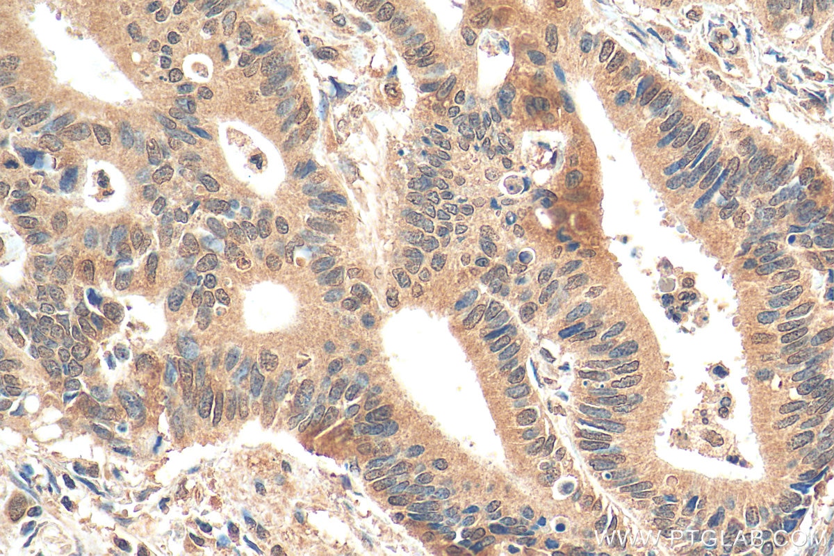 Immunohistochemistry (IHC) staining of human colon cancer tissue using FMR1 Monoclonal antibody (66548-1-Ig)