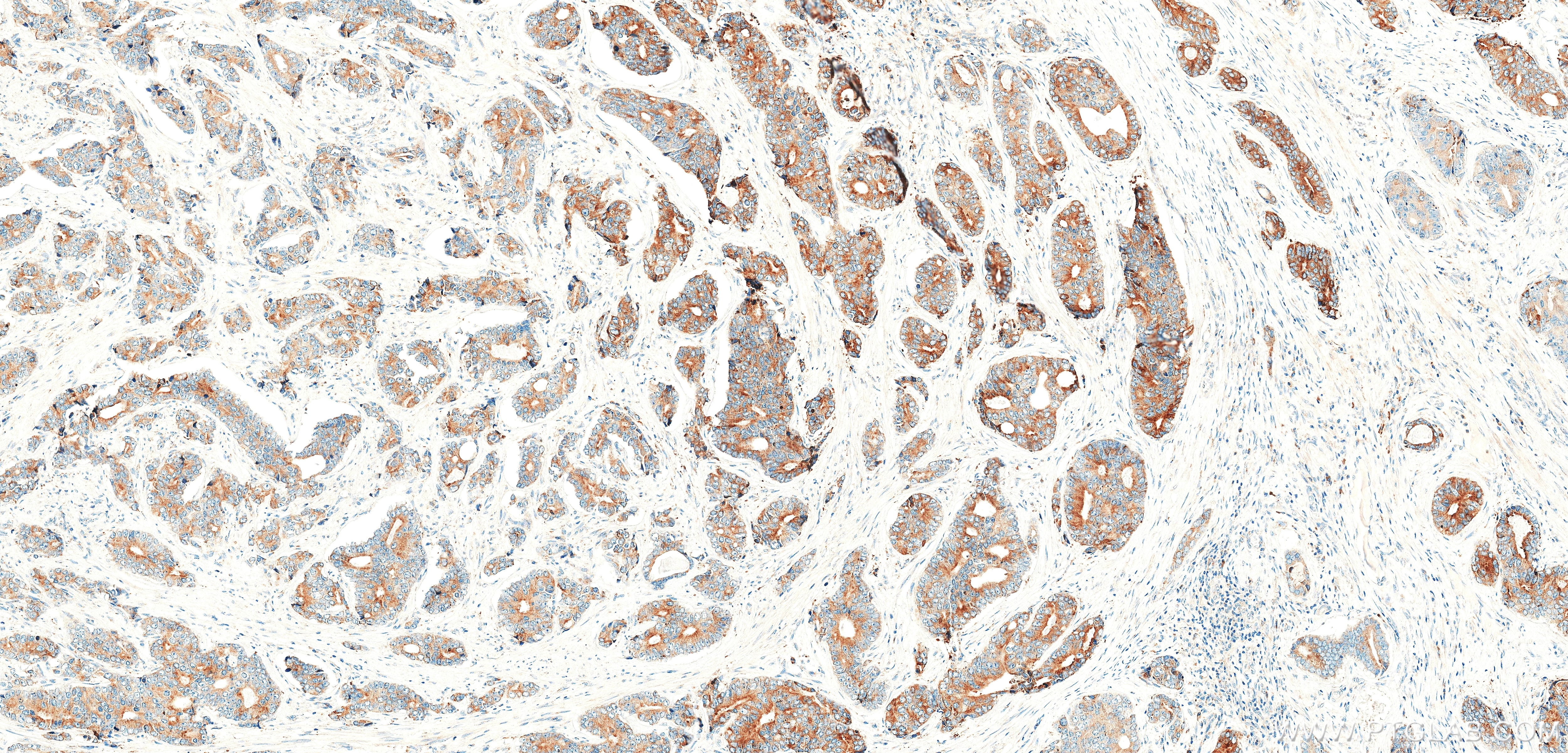 IHC staining of human prostate cancer using 87803-1-RR Immunohistochemistry (IHC) staining of human prostate cancer tissue using FMR1 Recombinant monoclonal antibody (87803-1-RR)