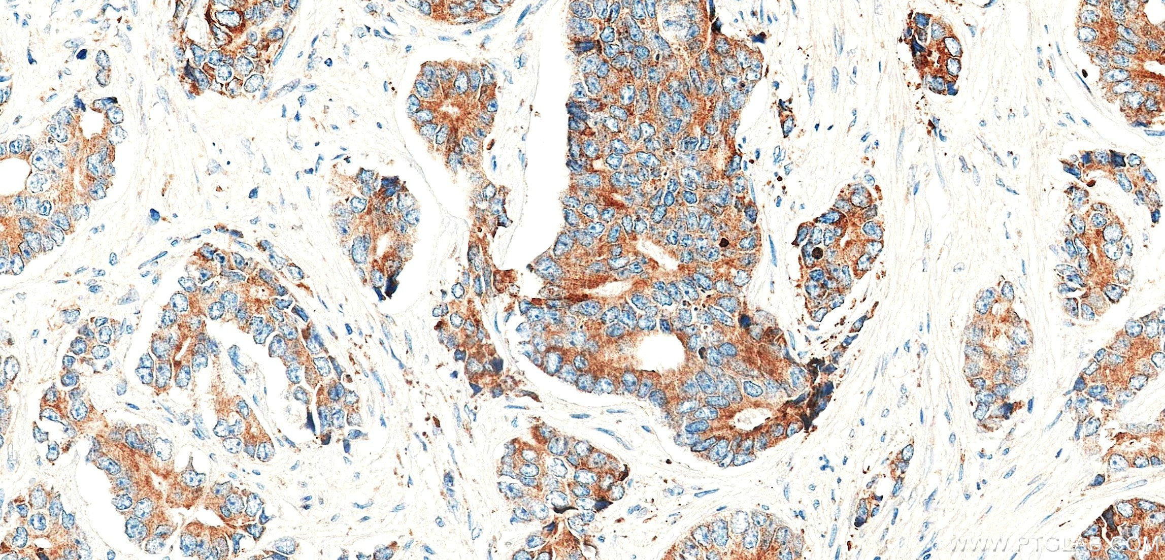 IHC staining of human prostate cancer using 87803-1-RR Immunohistochemistry (IHC) staining of human prostate cancer tissue using FMR1 Recombinant monoclonal antibody (87803-1-RR)