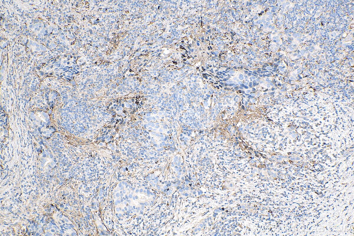 Immunohistochemistry (IHC) staining of human breast cancer tissue using Fibronectin Polyclonal antibody (15613-1-AP)