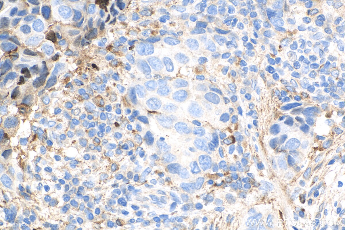 IHC staining of human breast cancer using 15613-1-AP