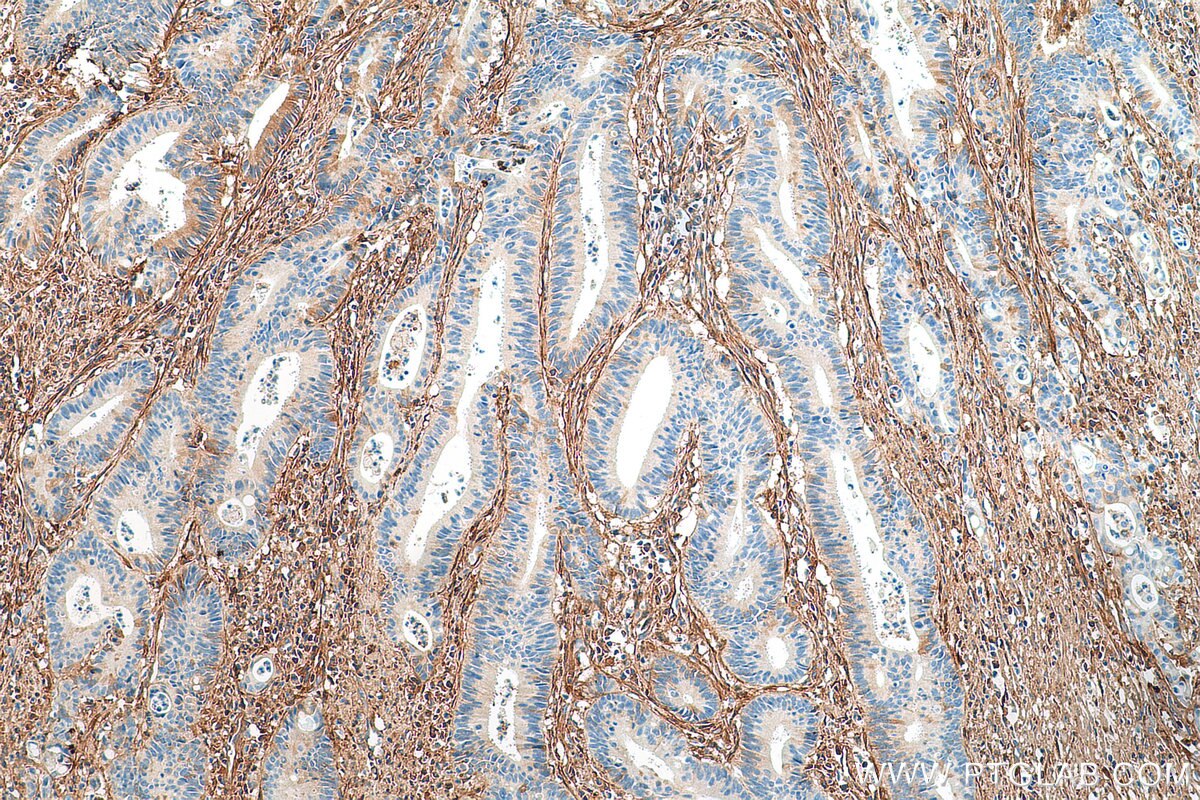 IHC staining of human colon cancer using 15613-1-AP