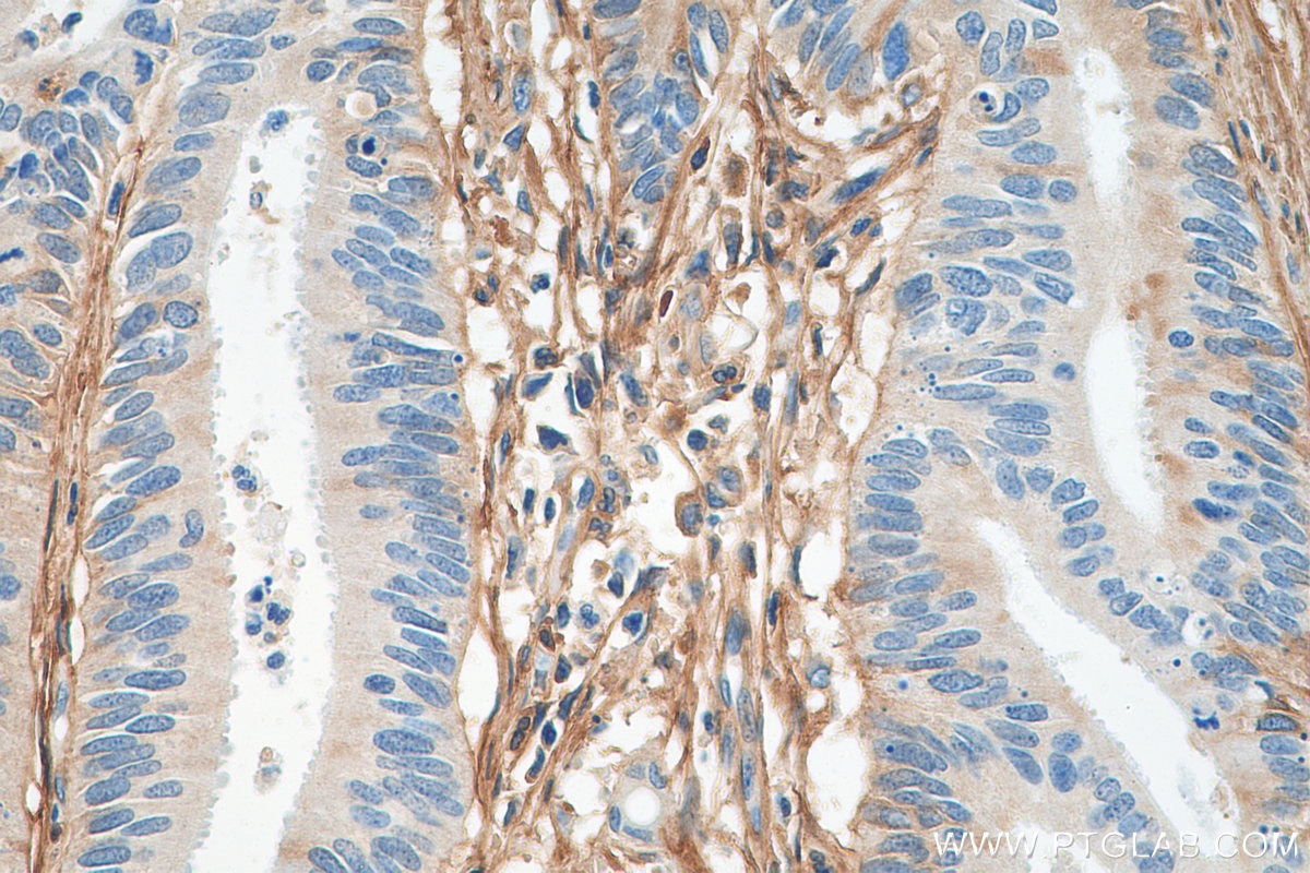Immunohistochemistry (IHC) staining of human colon cancer tissue using Fibronectin Polyclonal antibody (15613-1-AP)
