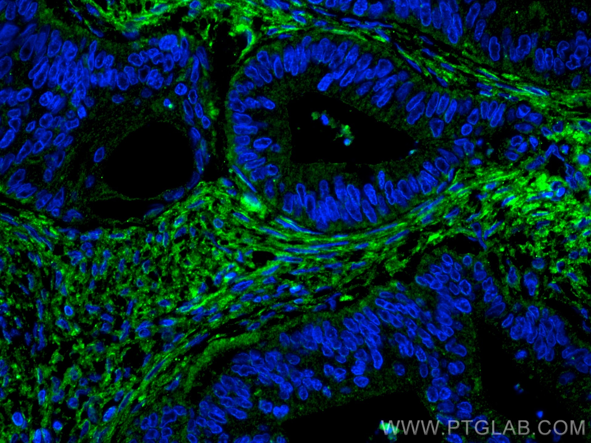 Immunofluorescence (IF) / fluorescent staining of human colon cancer tissue using Fibronectin Monoclonal antibody (66042-1-Ig)