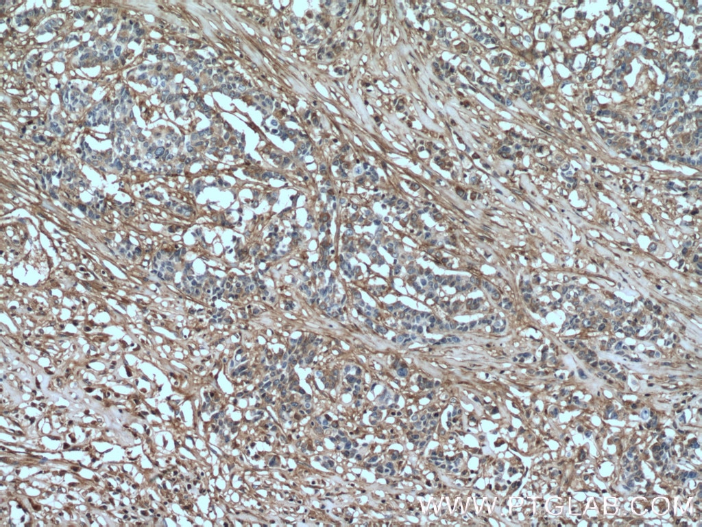 Immunohistochemistry (IHC) staining of human colon cancer tissue using Fibronectin Monoclonal antibody (66042-1-Ig)