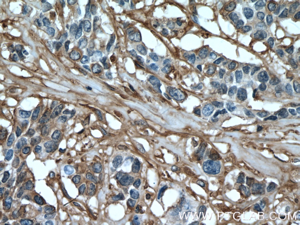 Immunohistochemistry (IHC) staining of human colon cancer tissue using Fibronectin Monoclonal antibody (66042-1-Ig)