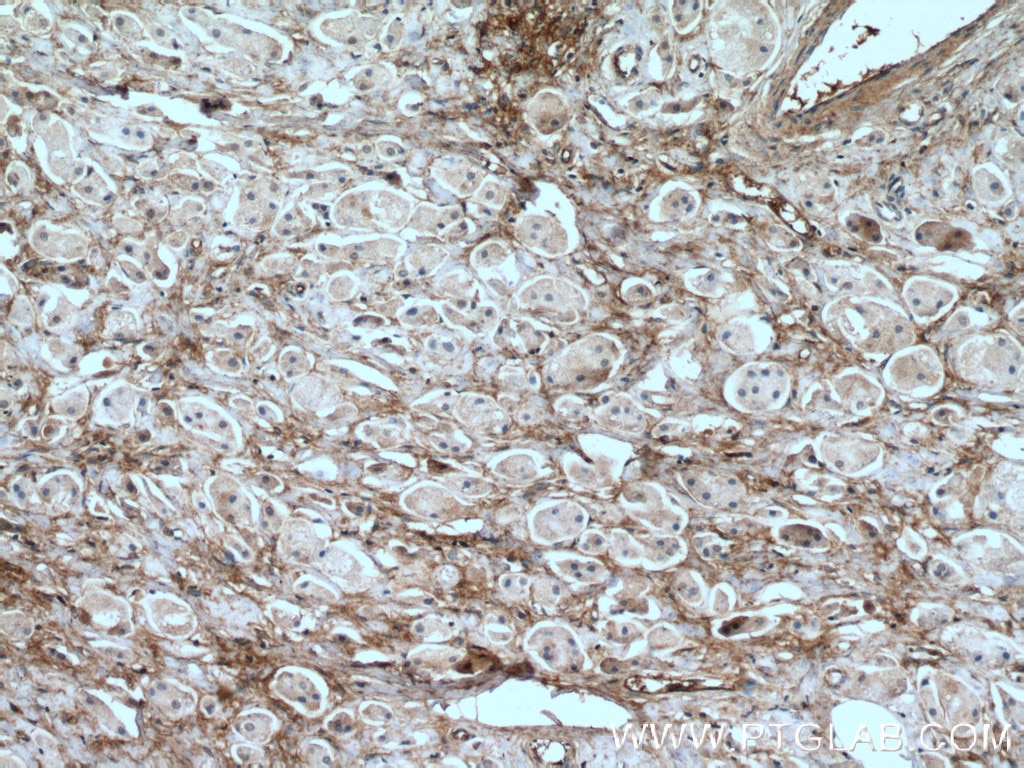 IHC staining of human breast cancer using 66042-1-Ig