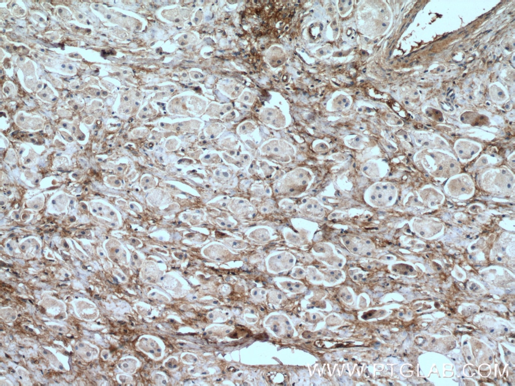 Immunohistochemistry (IHC) staining of human breast cancer tissue using Fibronectin Monoclonal antibody (66042-1-Ig)