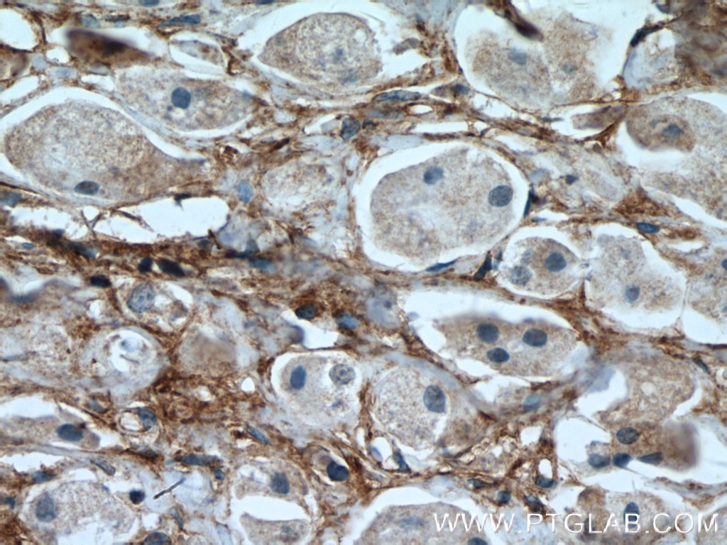 Immunohistochemistry (IHC) staining of human breast cancer tissue using Fibronectin Monoclonal antibody (66042-1-Ig)