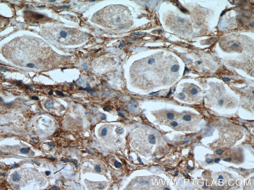 IHC staining of human breast cancer using 66042-1-Ig