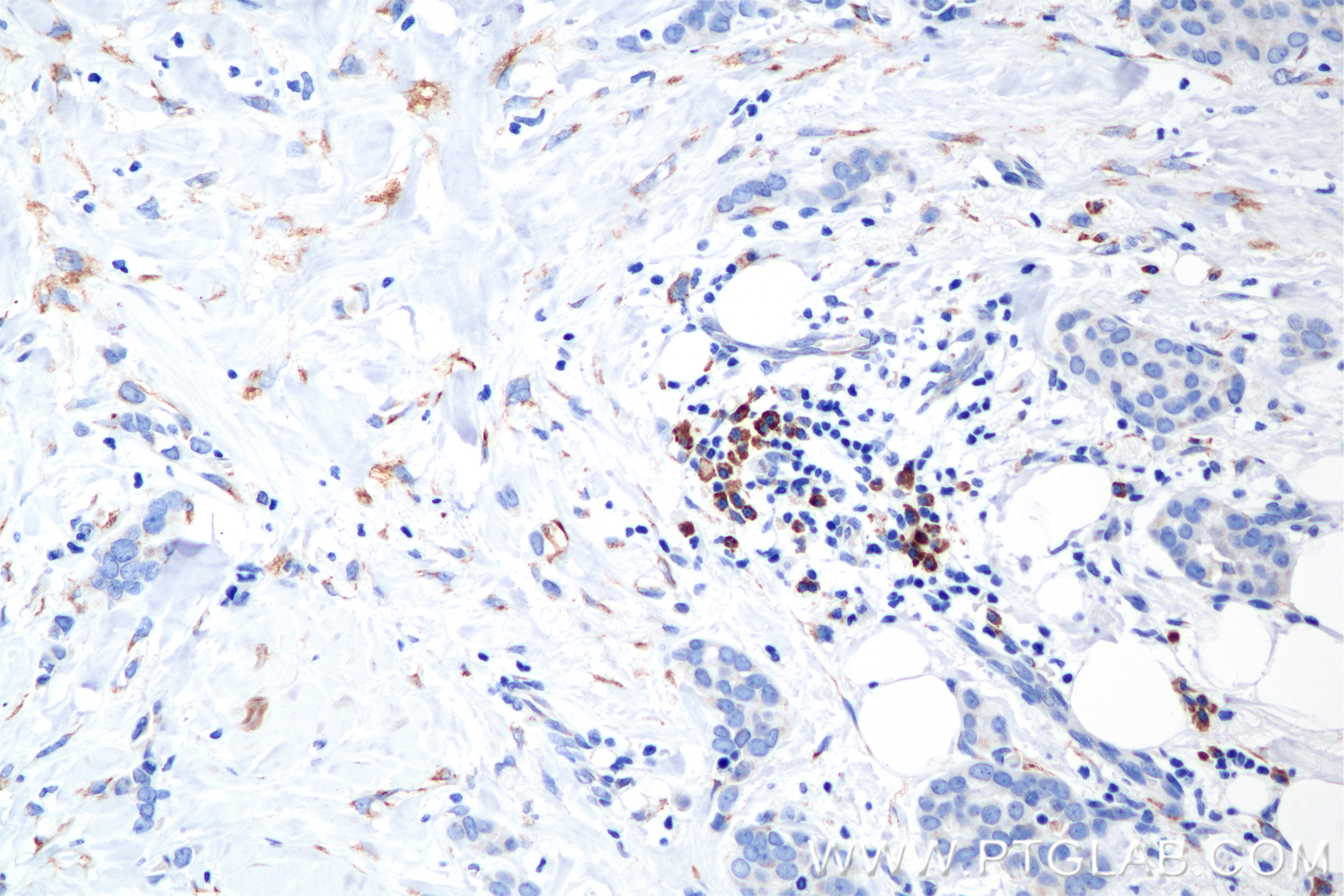 Immunohistochemistry (IHC) staining of human breast cancer tissue using FNDC3B Recombinant antibody (86272-1-RR)
