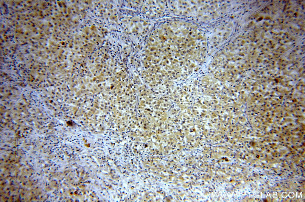 Immunohistochemistry (IHC) staining of human renal cell carcinoma tissue using FNIP1 Polyclonal antibody (19847-1-AP)