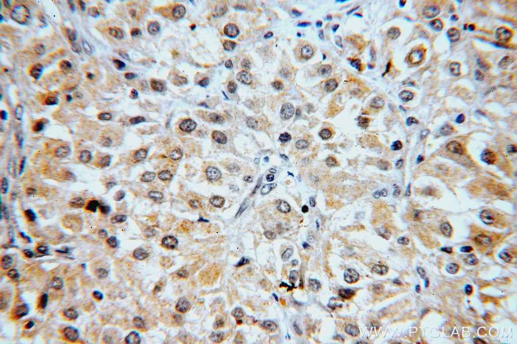 Immunohistochemistry (IHC) staining of human renal cell carcinoma tissue using FNIP1 Polyclonal antibody (19847-1-AP)