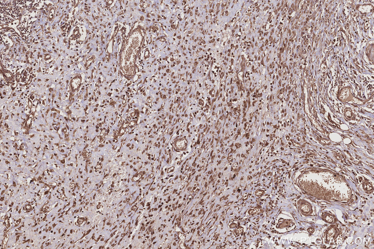 Immunohistochemistry (IHC) staining of human colon cancer tissue using FNTA Polyclonal antibody (12274-1-AP)