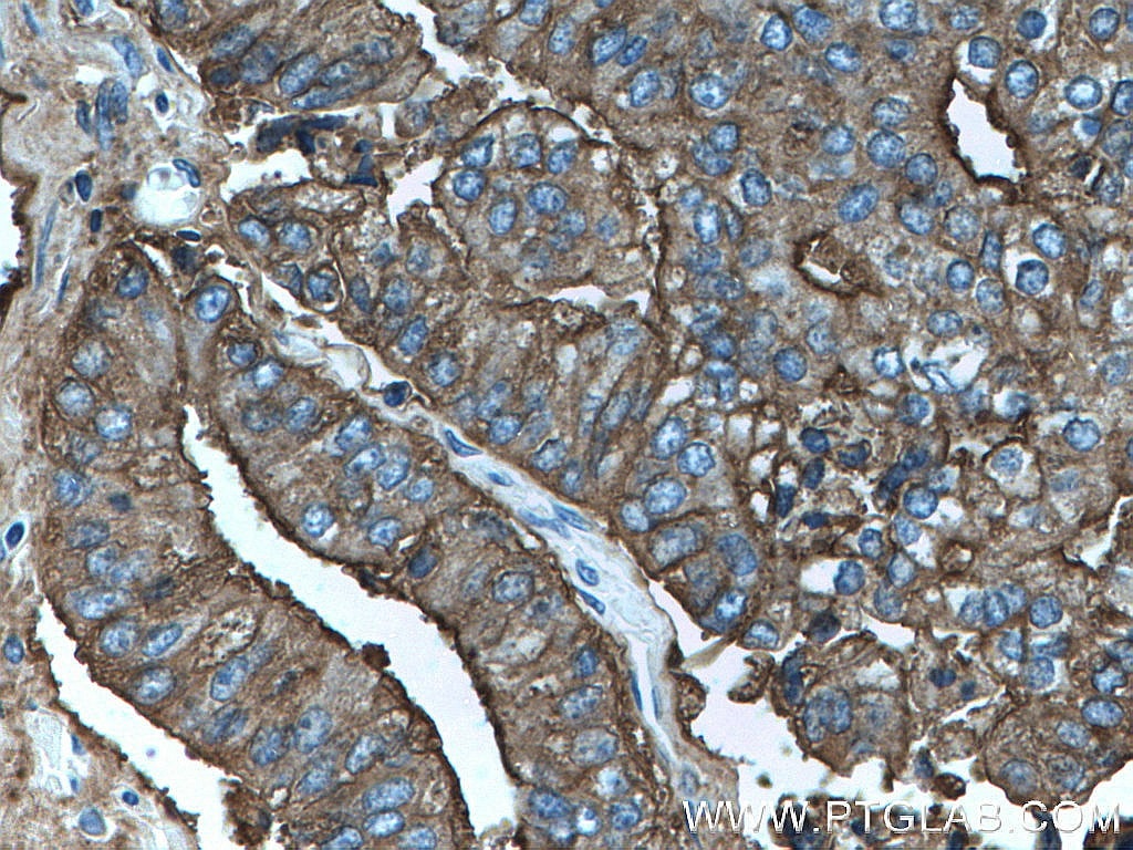 Immunohistochemistry (IHC) staining of human prostate cancer tissue using PSMA/GCPII Polyclonal antibody (13163-1-AP)