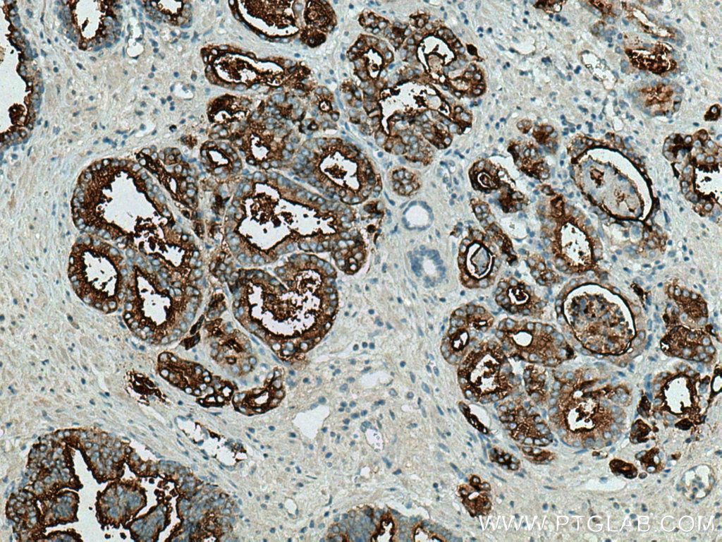 IHC staining of human prostate cancer using 13163-1-AP