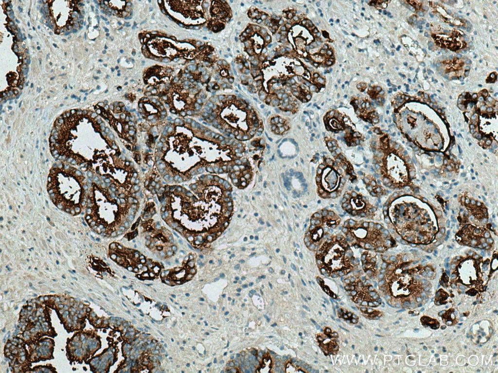 Immunohistochemistry (IHC) staining of human prostate cancer tissue using PSMA/GCPII Polyclonal antibody (13163-1-AP)