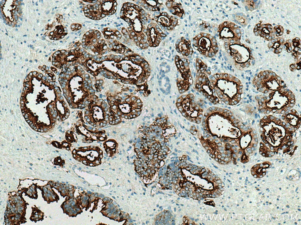 IHC staining of human prostate cancer using 13163-1-AP