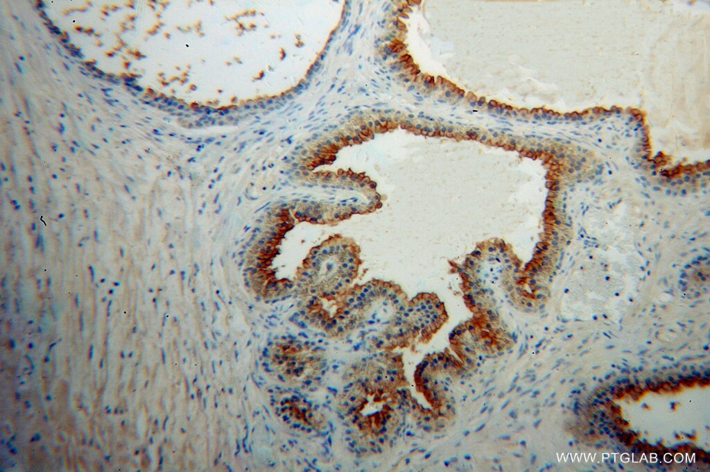 Immunohistochemistry (IHC) staining of human gliomas tissue using PSMA/GCPII Polyclonal antibody (13163-1-AP)