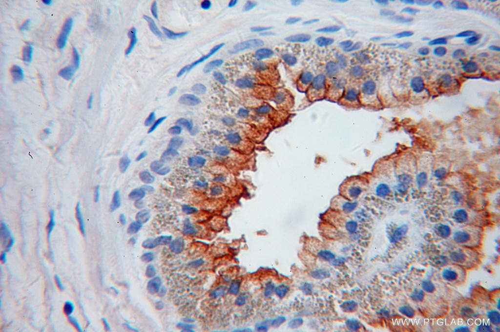 Immunohistochemistry (IHC) staining of human gliomas tissue using PSMA/GCPII Polyclonal antibody (13163-1-AP)