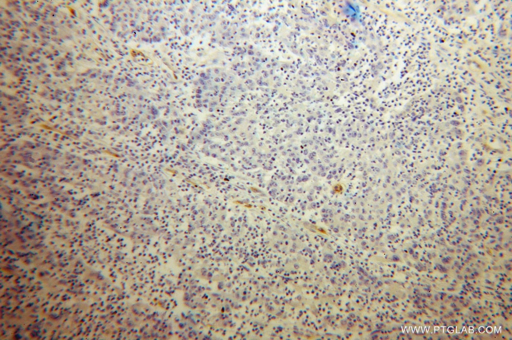 IHC staining of human colon cancer using 13163-1-AP