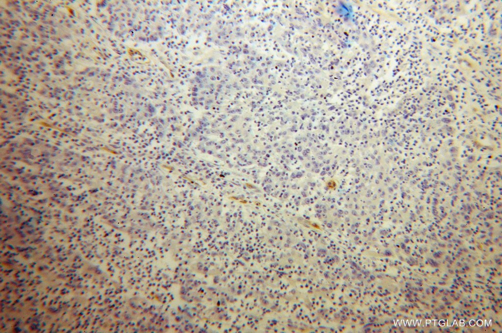 Immunohistochemistry (IHC) staining of human colon cancer tissue using PSMA/GCPII Polyclonal antibody (13163-1-AP)