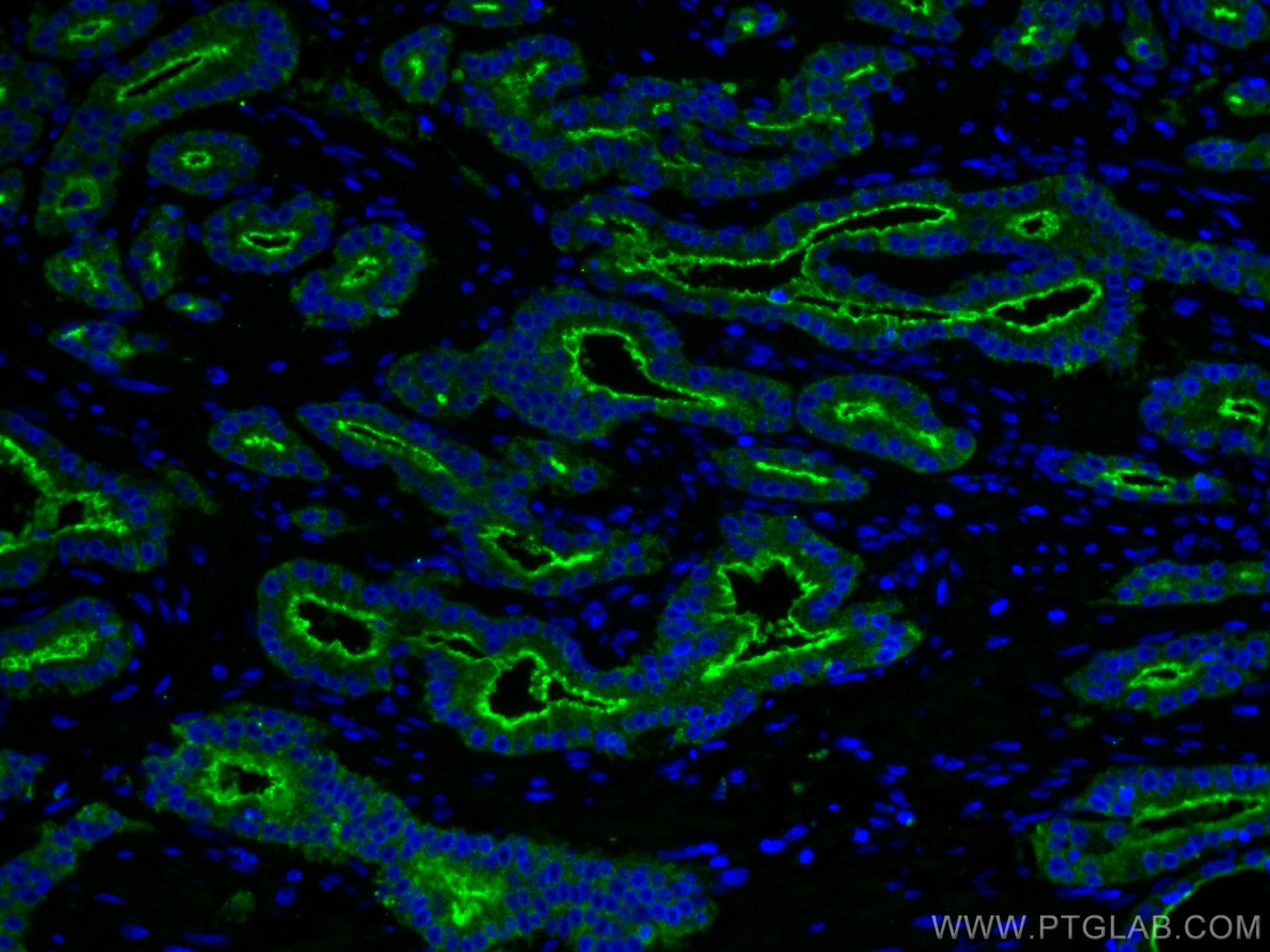 IF Staining of human prostate cancer using 66678-1-Ig