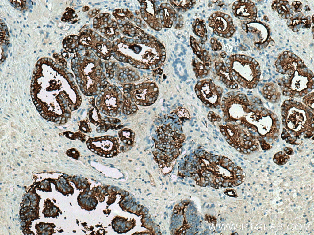 Immunohistochemistry (IHC) staining of human prostate cancer tissue using PSMA/GCPII Monoclonal antibody (66678-1-Ig)