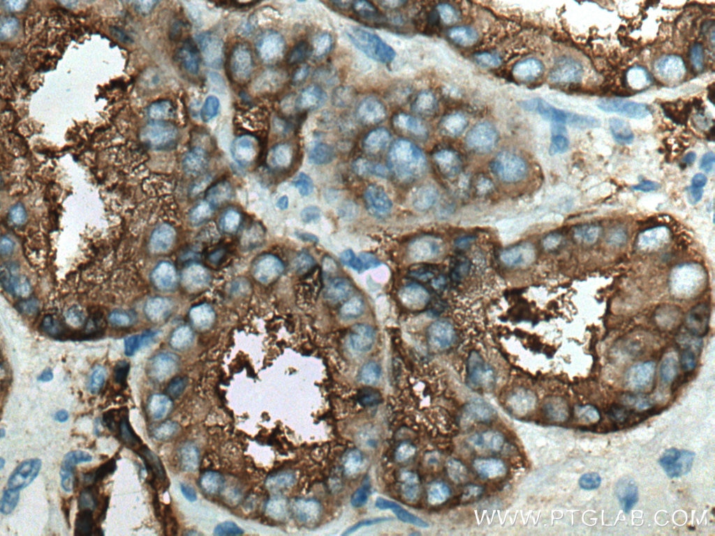Immunohistochemistry (IHC) staining of human prostate cancer tissue using PSMA/GCPII Monoclonal antibody (66678-1-Ig)