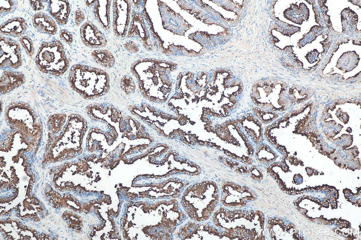 IHC staining of human prostate hyperplasia using 66678-1-Ig Immunohistochemistry (IHC) staining of human prostate hyperplasia tissue using PSMA/GCPII Monoclonal antibody (66678-1-Ig)