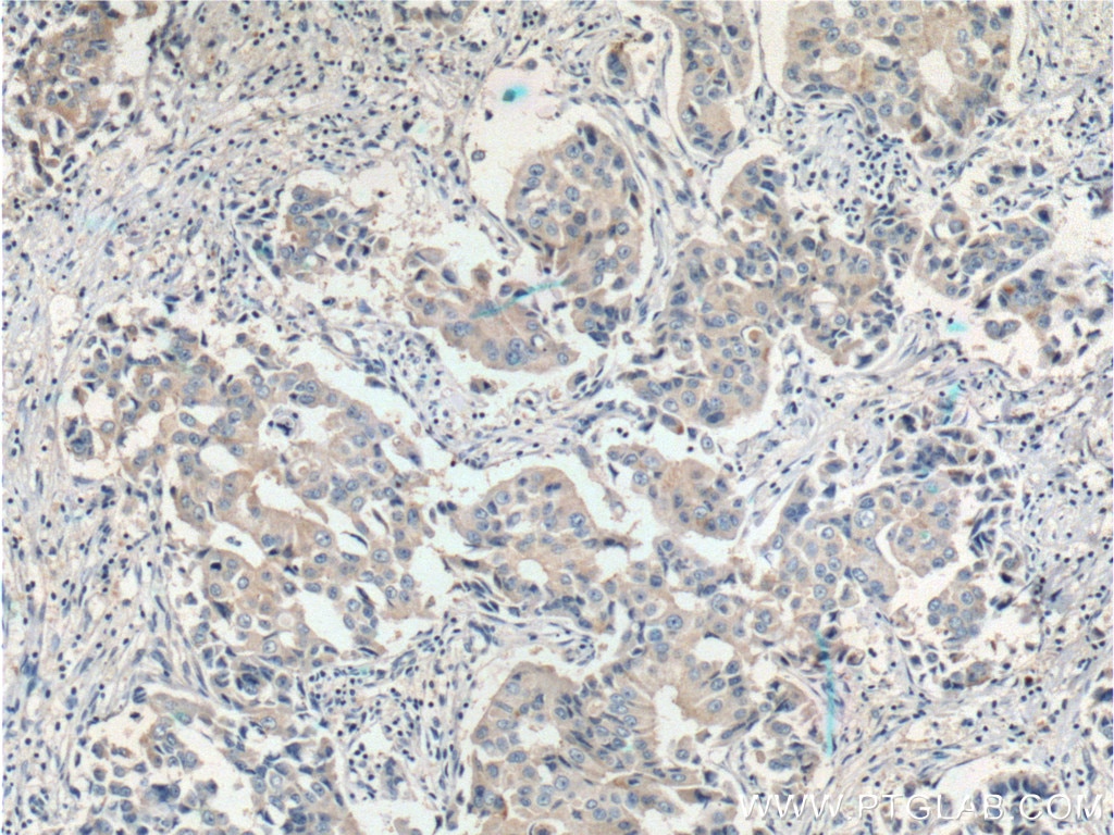 Immunohistochemistry (IHC) staining of human breast cancer tissue using FOLR1 Polyclonal antibody (23355-1-AP)