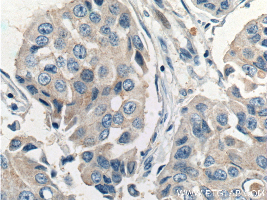 Immunohistochemistry (IHC) staining of human breast cancer tissue using FOLR1 Polyclonal antibody (23355-1-AP)