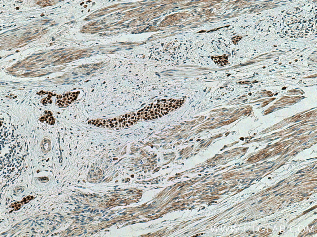 Immunohistochemistry (IHC) staining of human urothelial carcinoma tissue using FOXA1 Polyclonal antibody (20411-1-AP)