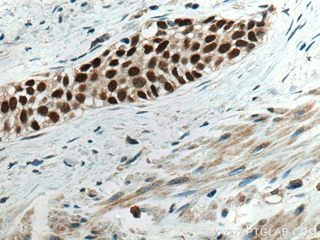 Immunohistochemistry (IHC) staining of human urothelial carcinoma tissue using FOXA1 Polyclonal antibody (20411-1-AP)