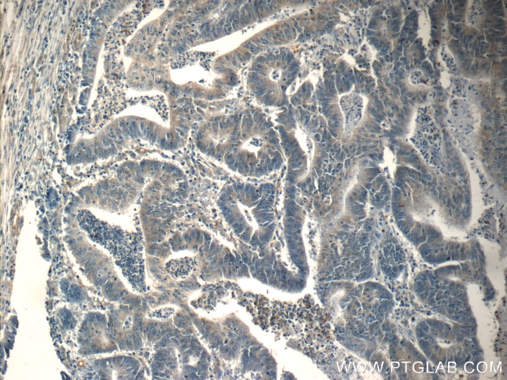 Immunohistochemistry (IHC) staining of human colon cancer tissue using FOXA2 Polyclonal antibody (22474-1-AP)