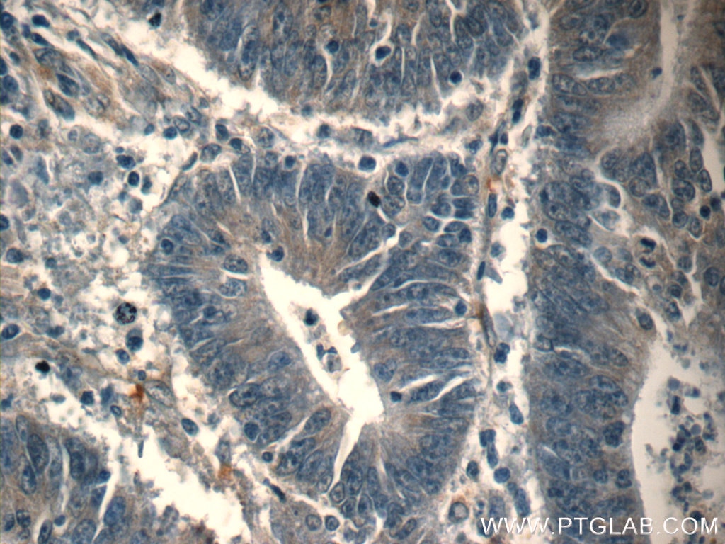 Immunohistochemistry (IHC) staining of human colon cancer tissue using FOXA2 Polyclonal antibody (22474-1-AP)