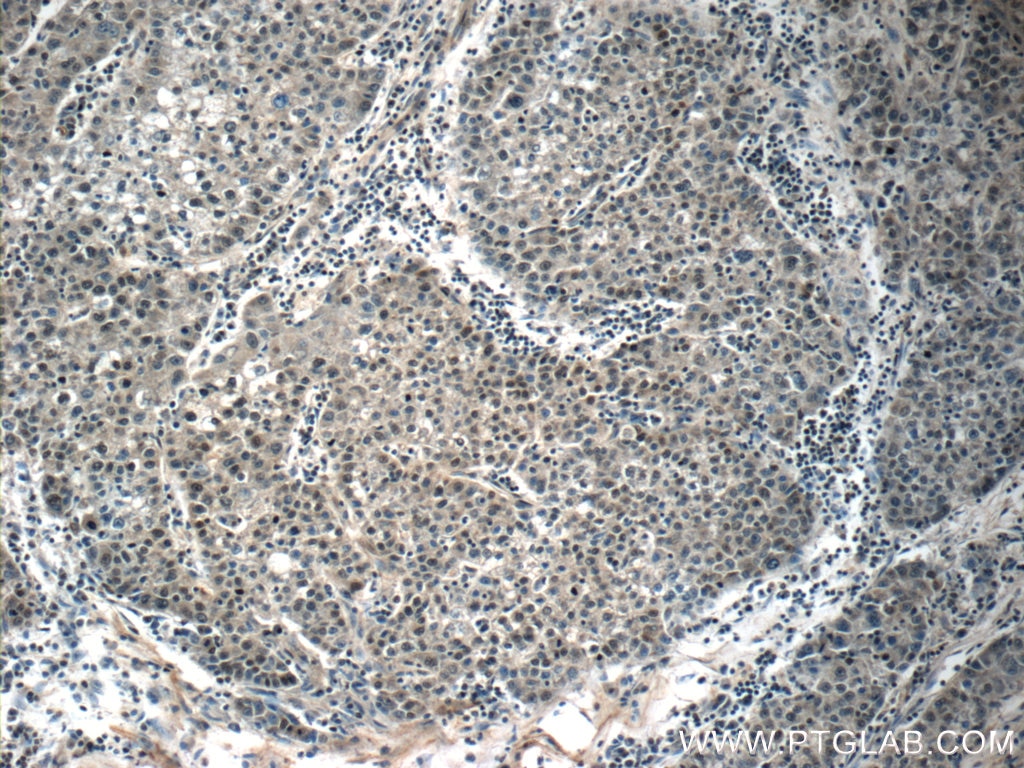 IHC staining of human liver cancer using 22474-1-AP