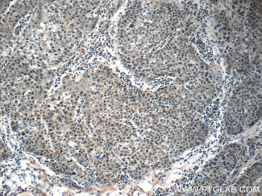 Immunohistochemistry (IHC) staining of human liver cancer tissue using FOXA2 Polyclonal antibody (22474-1-AP)