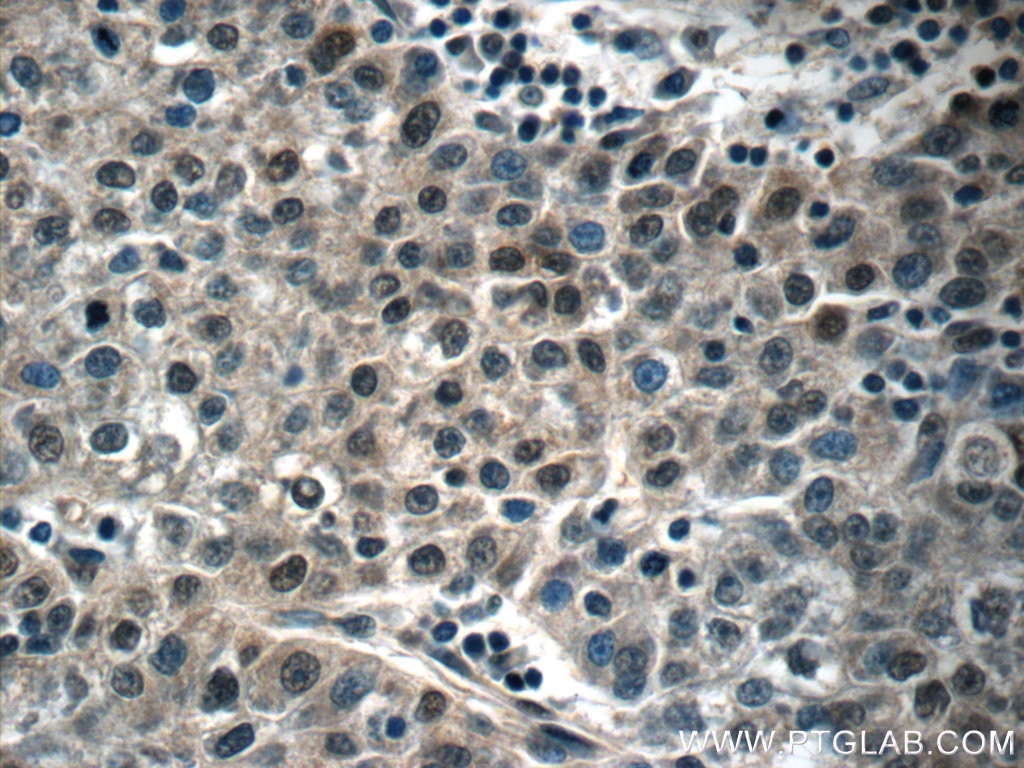 Immunohistochemistry (IHC) staining of human liver cancer tissue using FOXA2 Polyclonal antibody (22474-1-AP)
