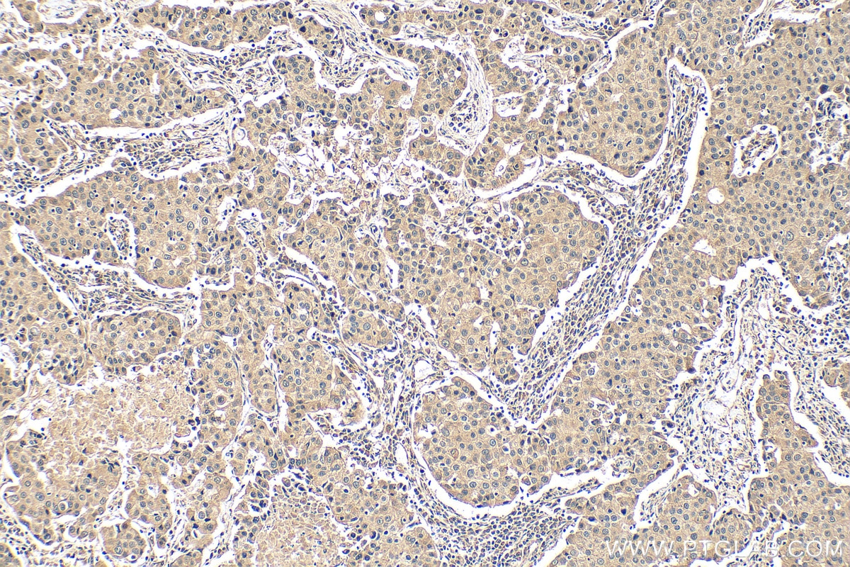 Immunohistochemistry (IHC) staining of human breast cancer tissue using FOXC2 Monoclonal antibody (68384-1-Ig)